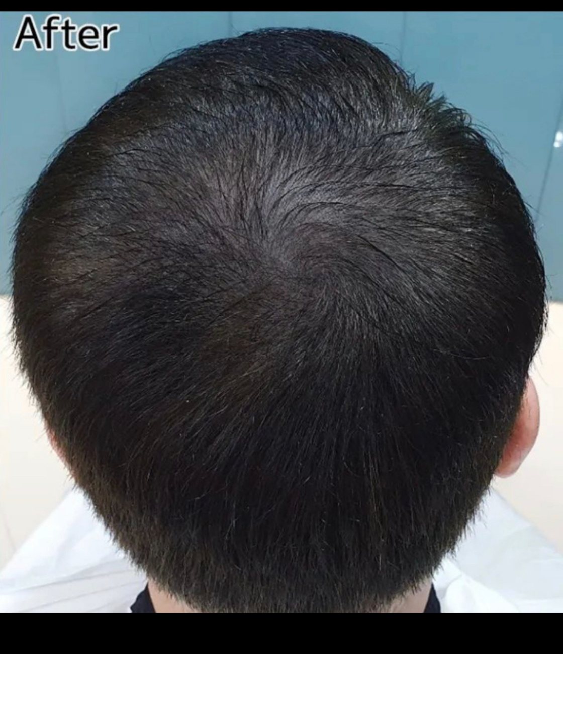 Perma Scalp After