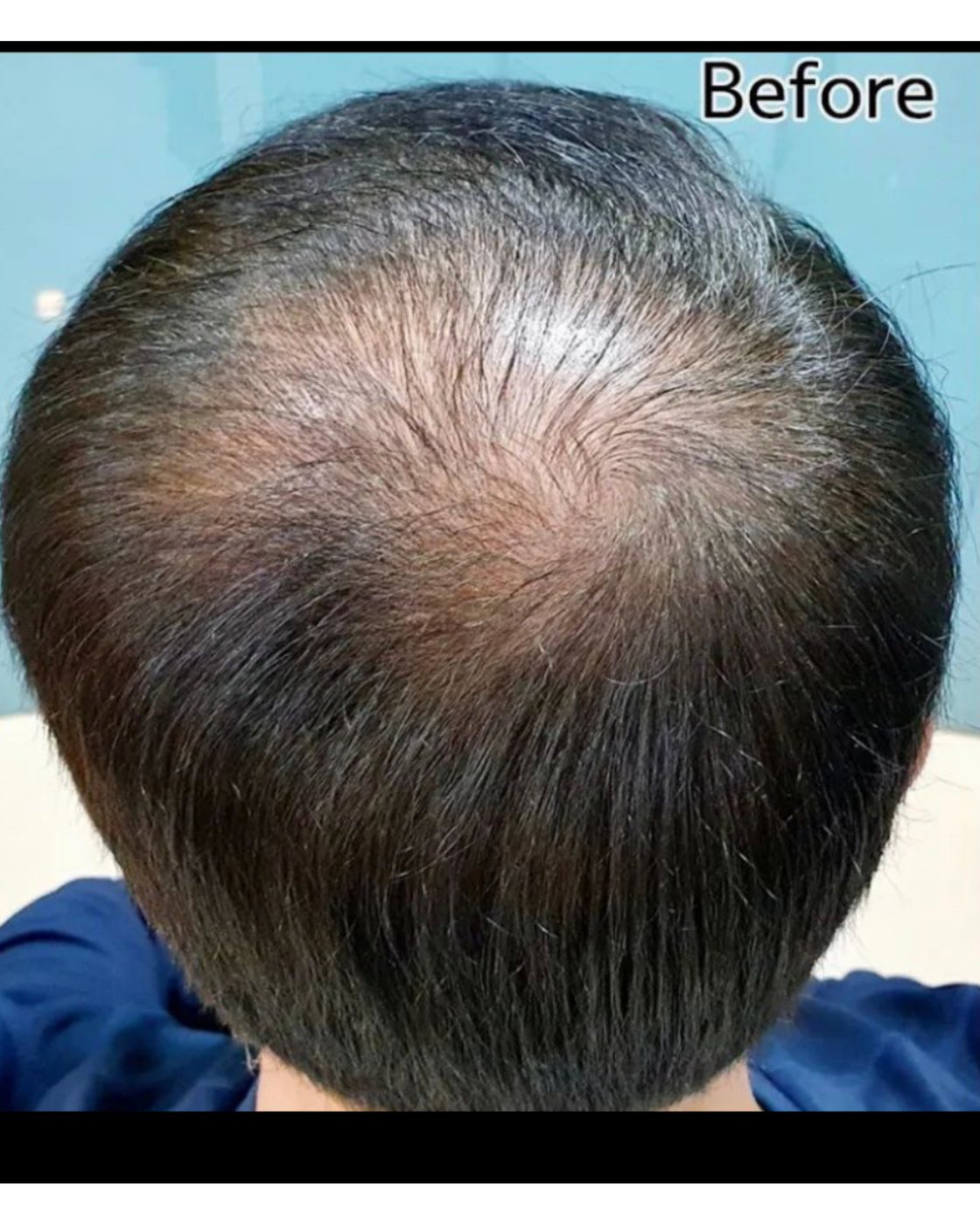 Perma Scalp Before