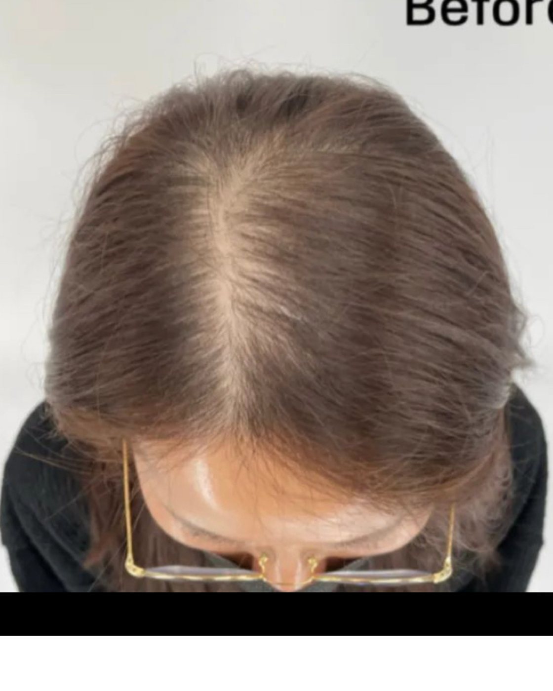 Perma Scalp Before